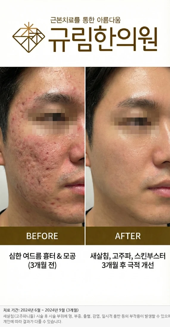 박스형 흉터 개선 전후