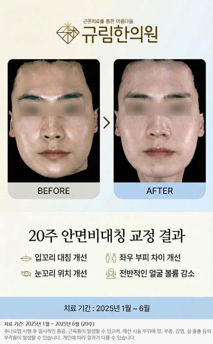 안면비대칭 교정 전후