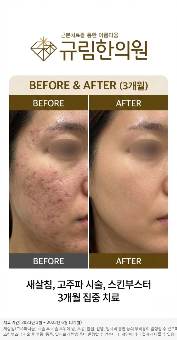 복합 흉터 치료 전후