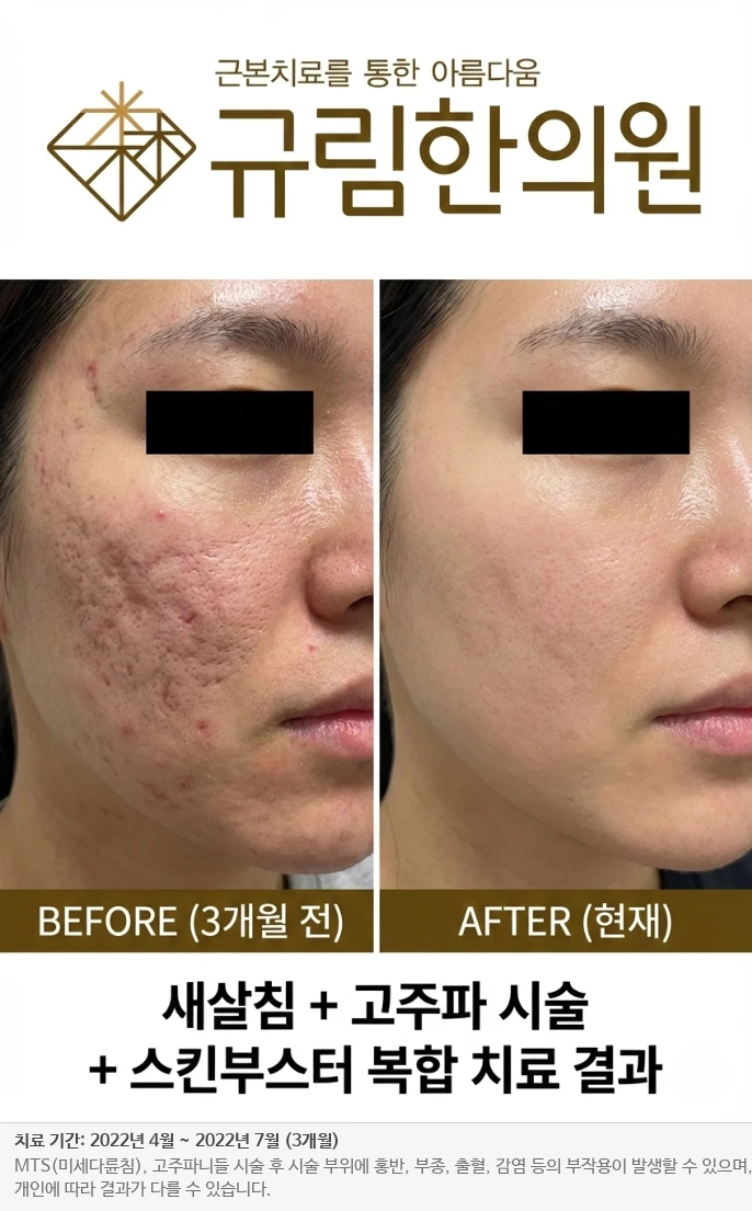 난치성 흉터 재생 전후