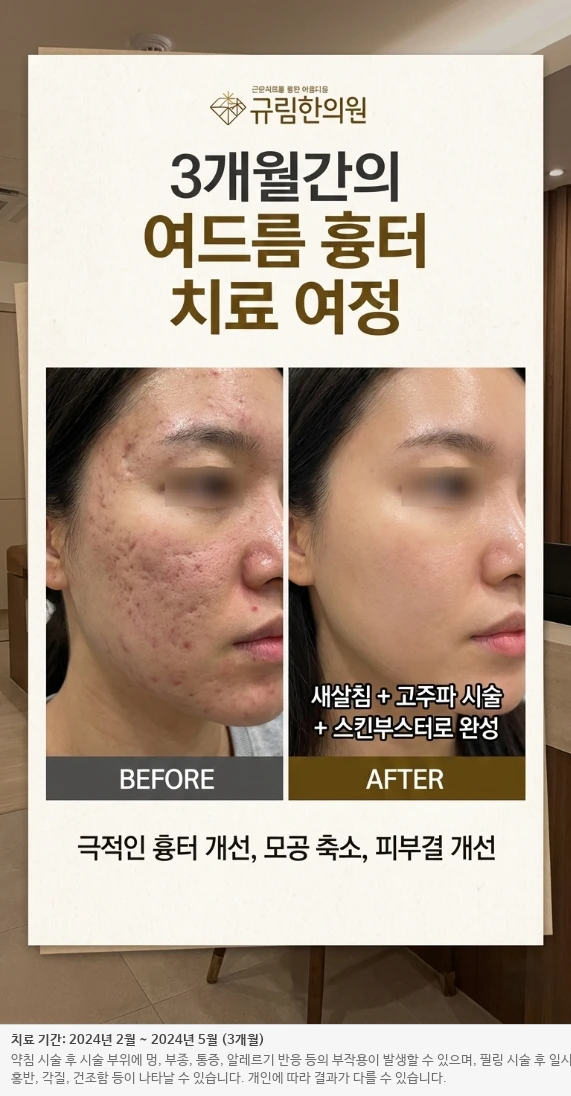 붉은 자국 흉터 치료 전후