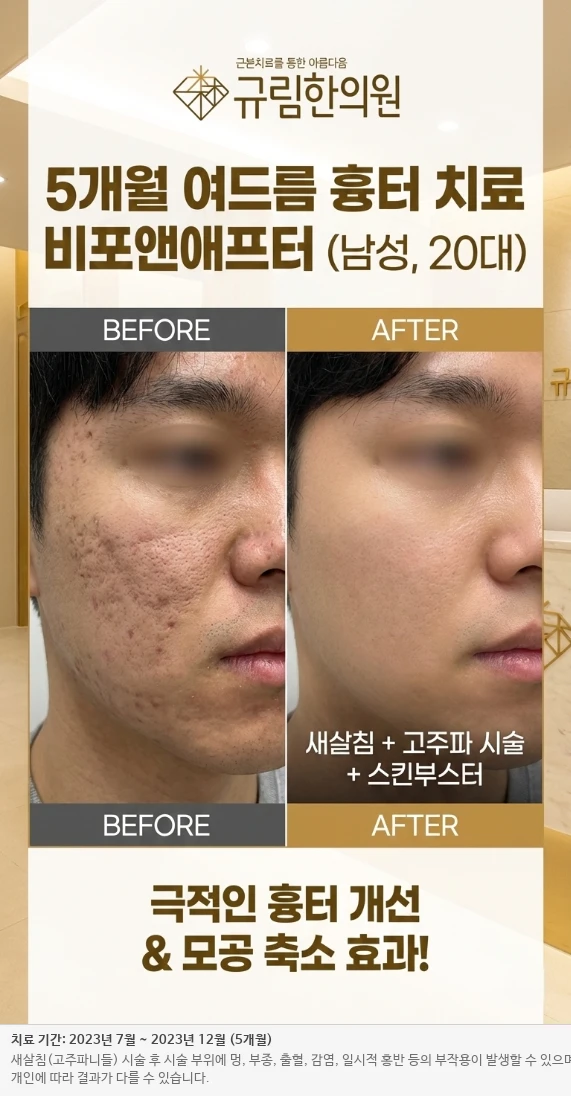 남성 심부 흉터 치료 전후