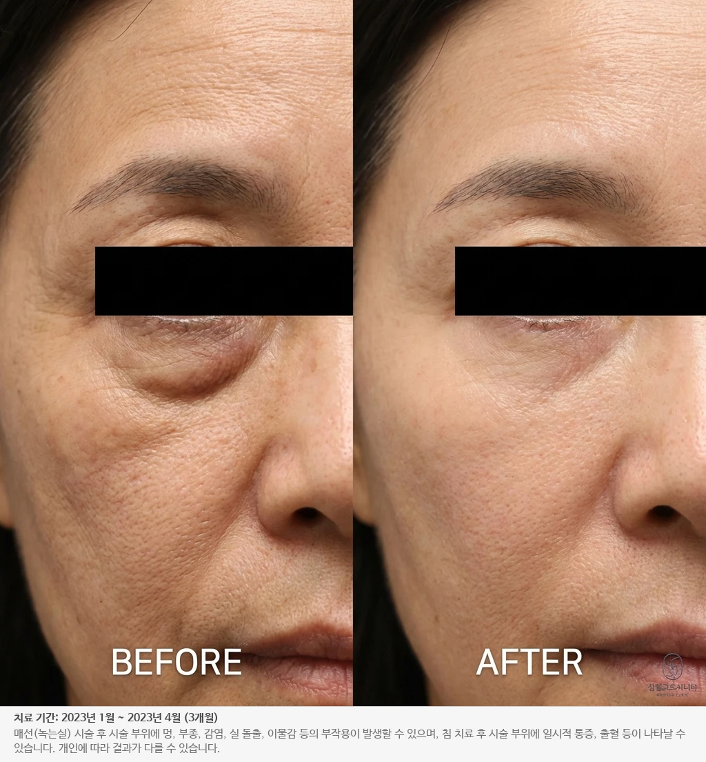 눈가 주름 개선 전후