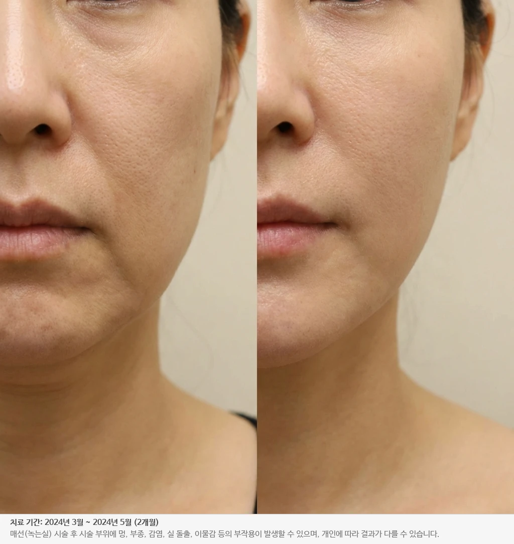 턱선 리프팅 전후
