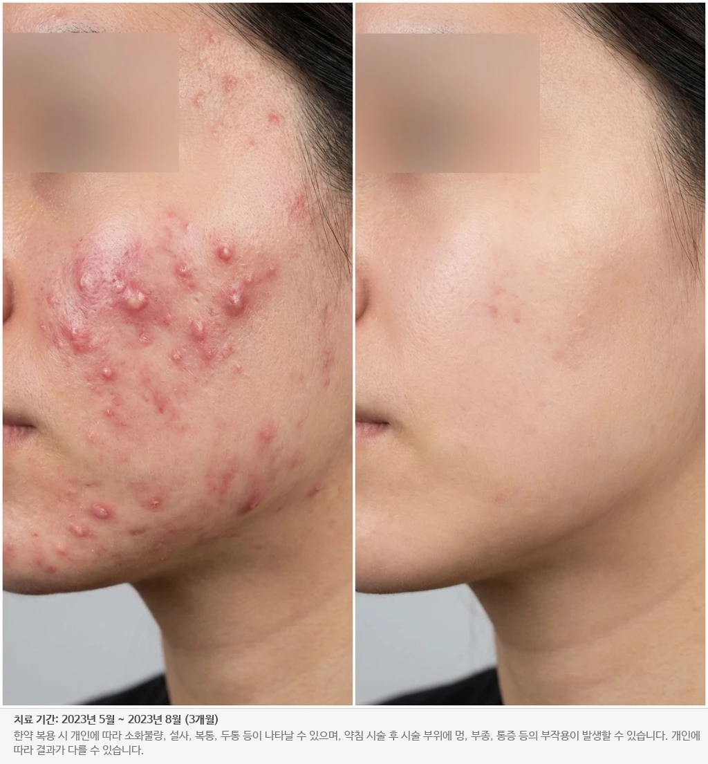 만성 여드름 붉은기 치료 전후
