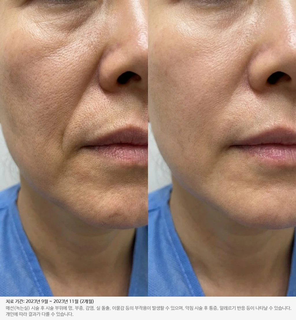 팔자주름 개선 전후