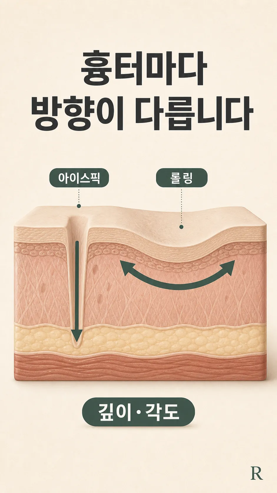 형태별 판단 카드 — 우물형·함몰형 분기