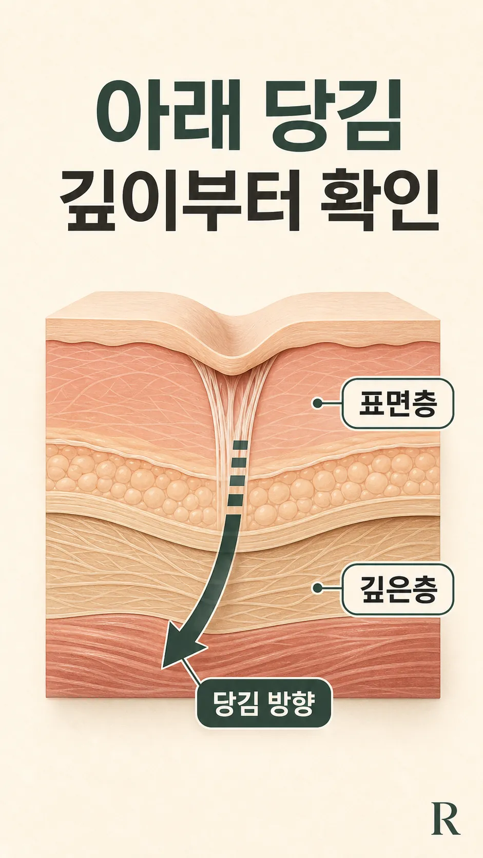 흉터 바닥 섬유 유착 단면 모식도