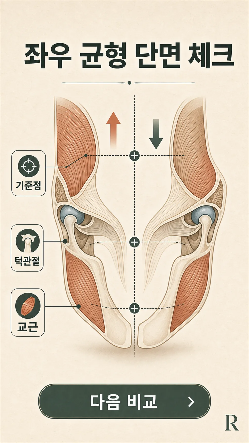 좌우 근막·교근 긴장 차이 단면 모식도
