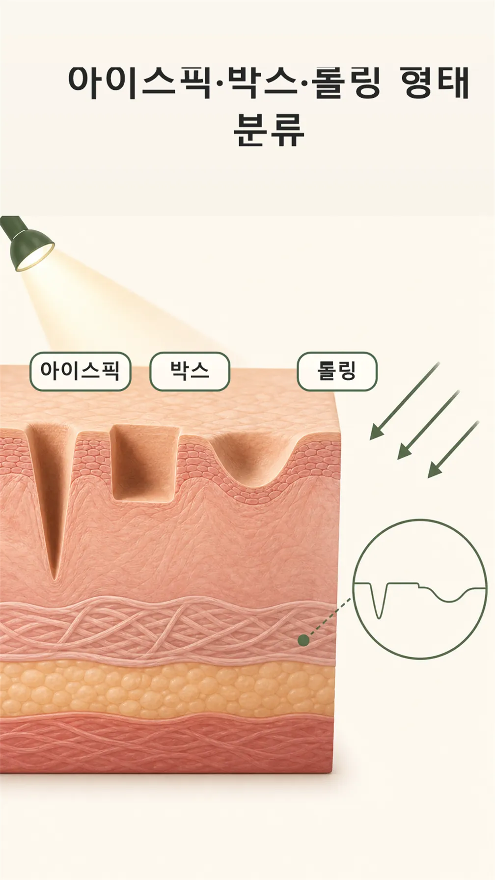 아이스픽·박스·롤링 형태 분류