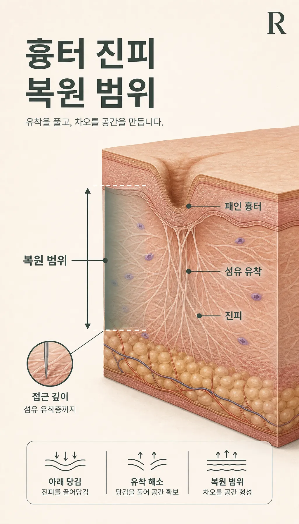 흉터 진피 단면 복원 범위 설명