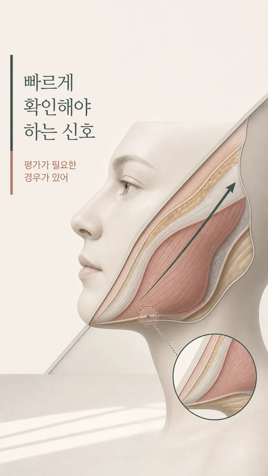 광대 턱선 근막 긴장 방향 단면 모식도