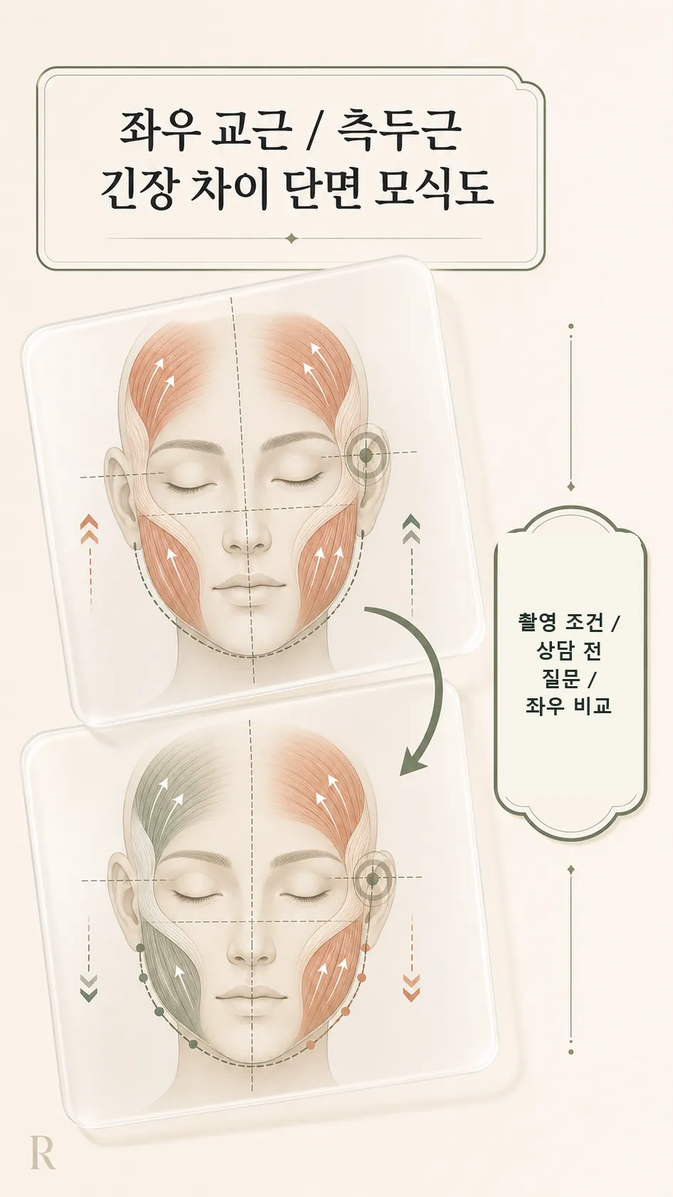 좌우 교근·측두근 긴장 차이 단면 모식도