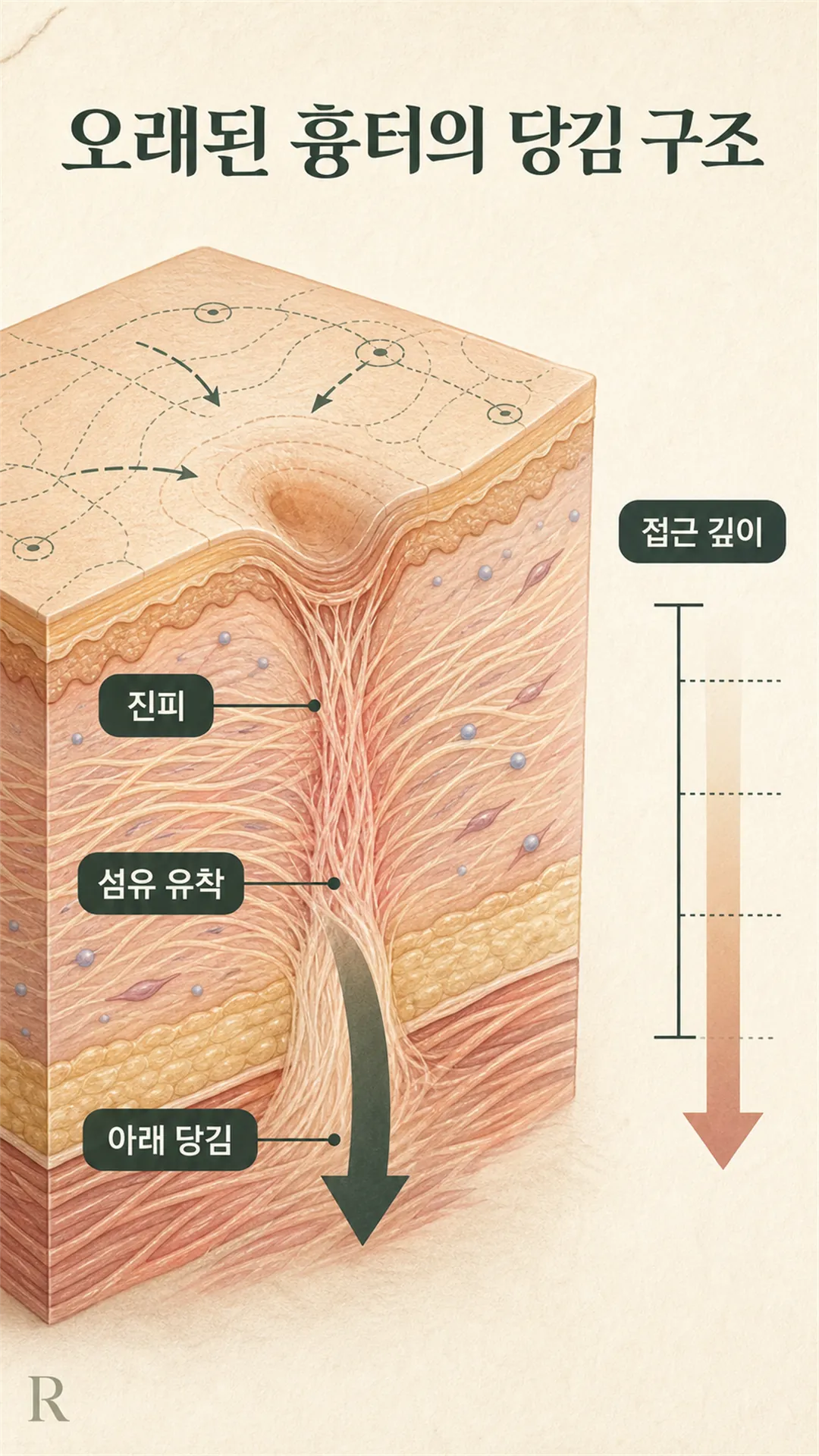 흉터 지도화 3줄 저장 카드