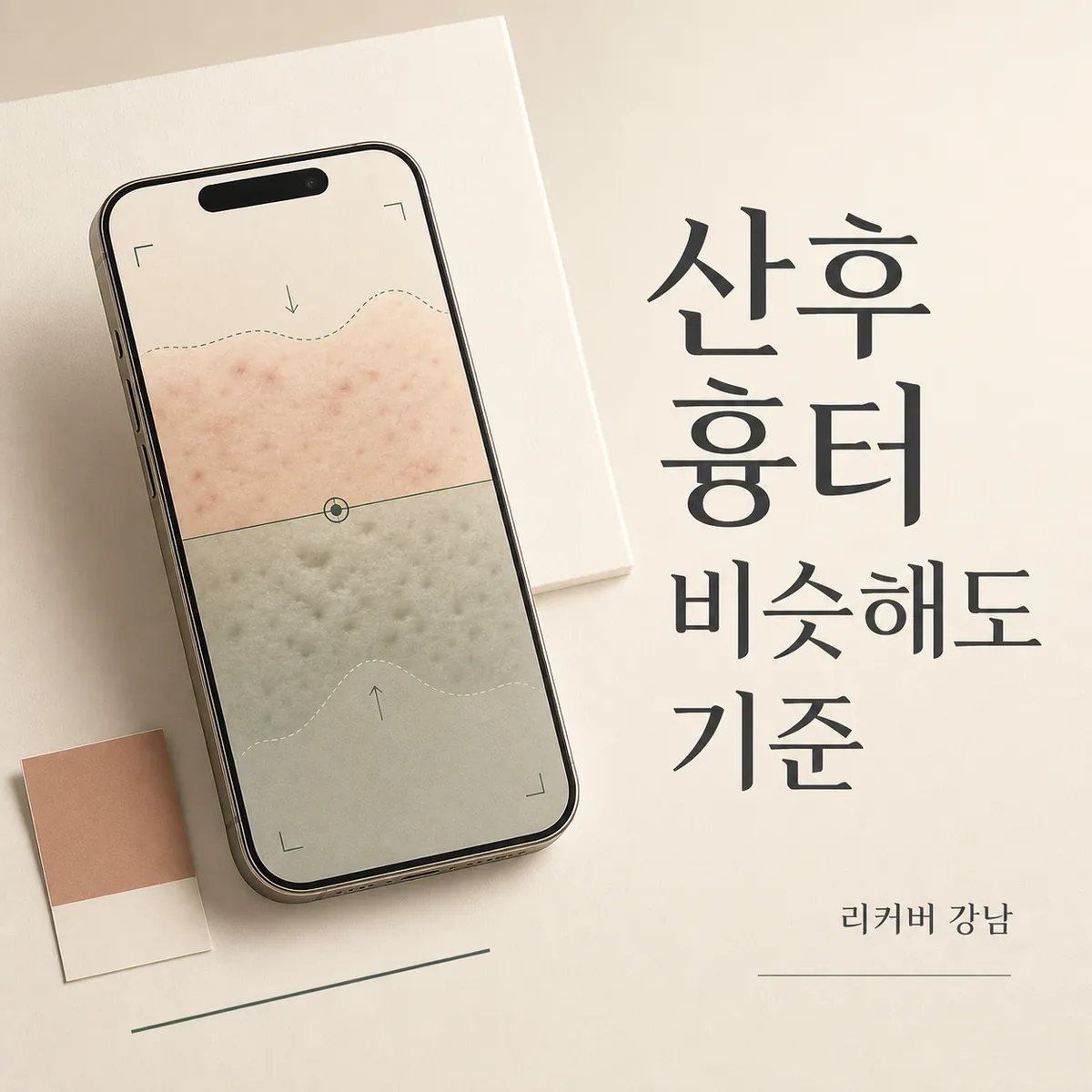 썸네일 - 산후 화농성여드름 흉터, 비슷해 보여도 접근이 달라지는 지점