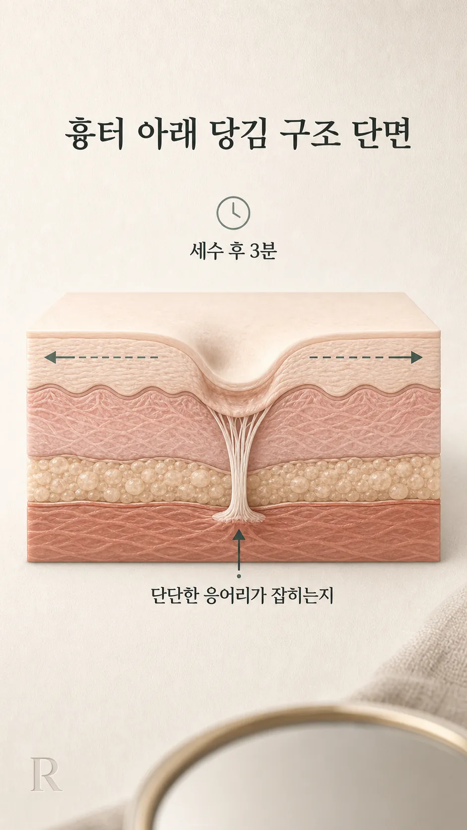 모공 흉터 아래 당김 구조 단면