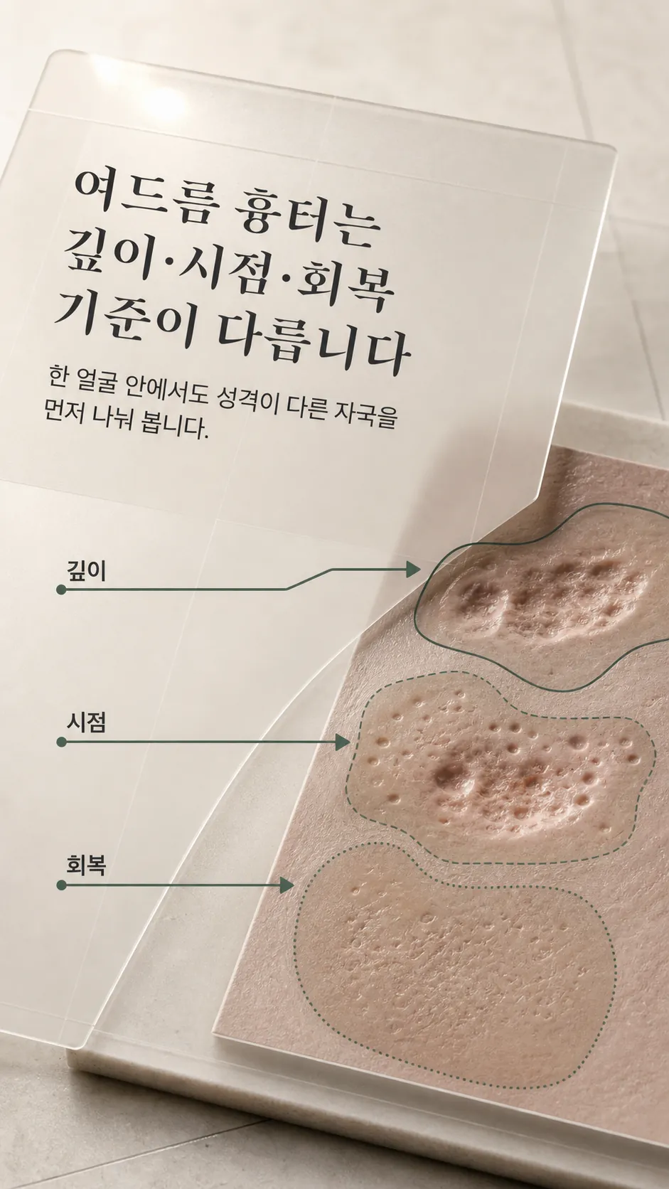 30대 여드름 흉터 깊이·시점·회복 기준 3라벨 요약
