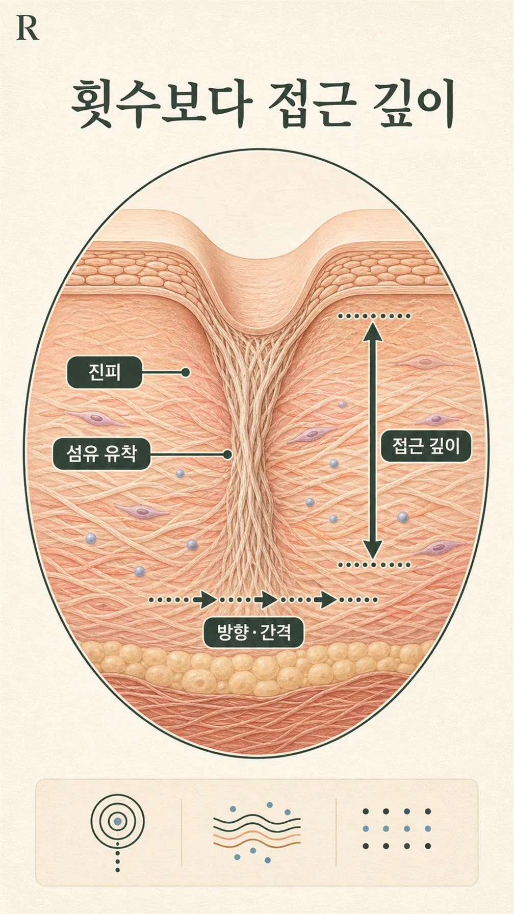 흉터 아래 당김 진피 단면 모식도