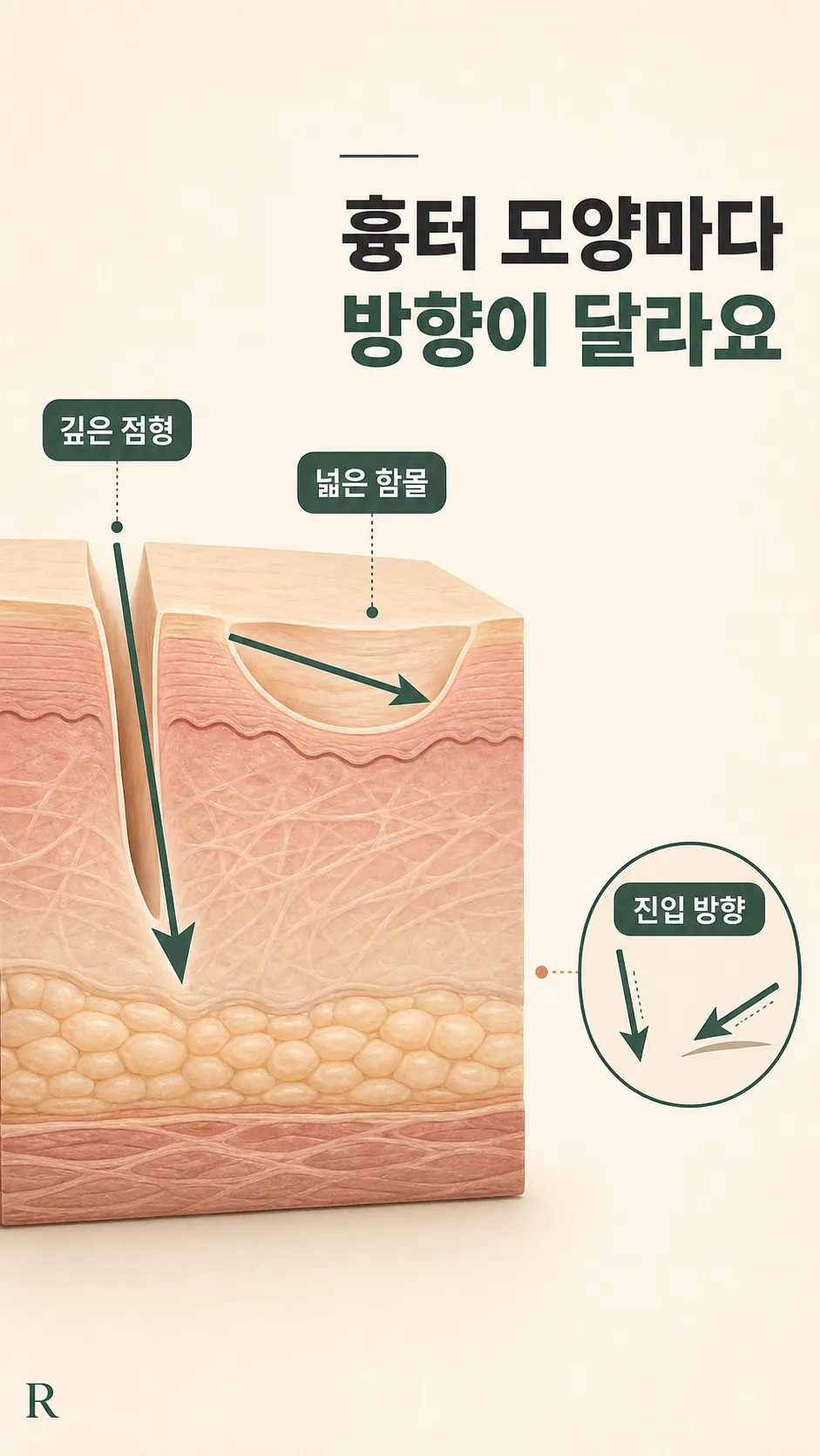 형태별 새살침 방향·깊이 화살표 단면