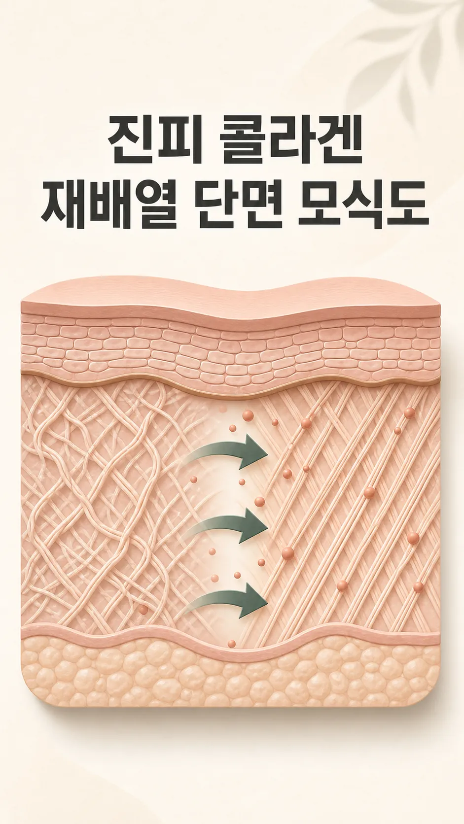 진피 콜라겐 재배열 단면 모식도