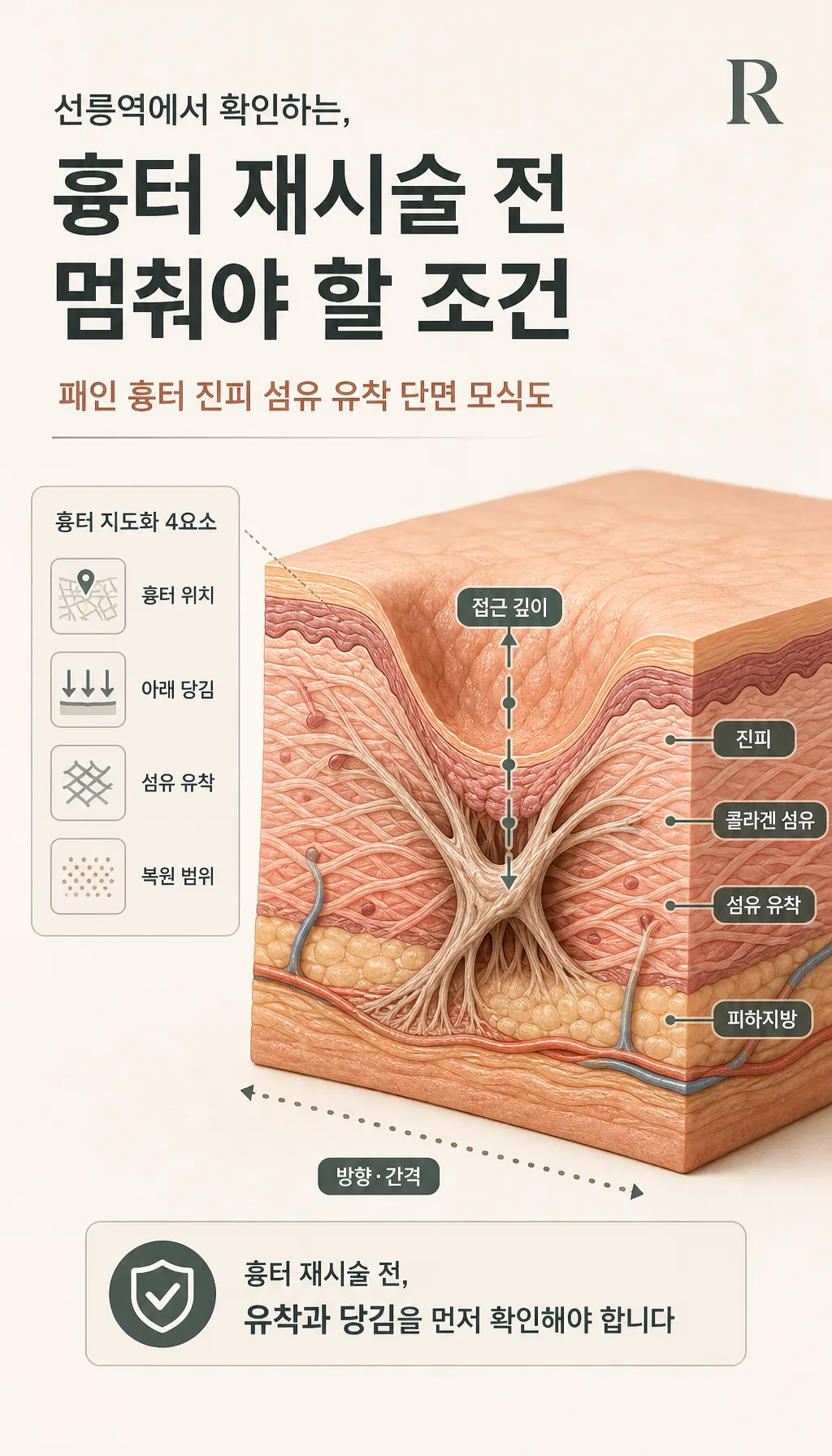 패인 흉터 진피 섬유 유착 단면 모식도
