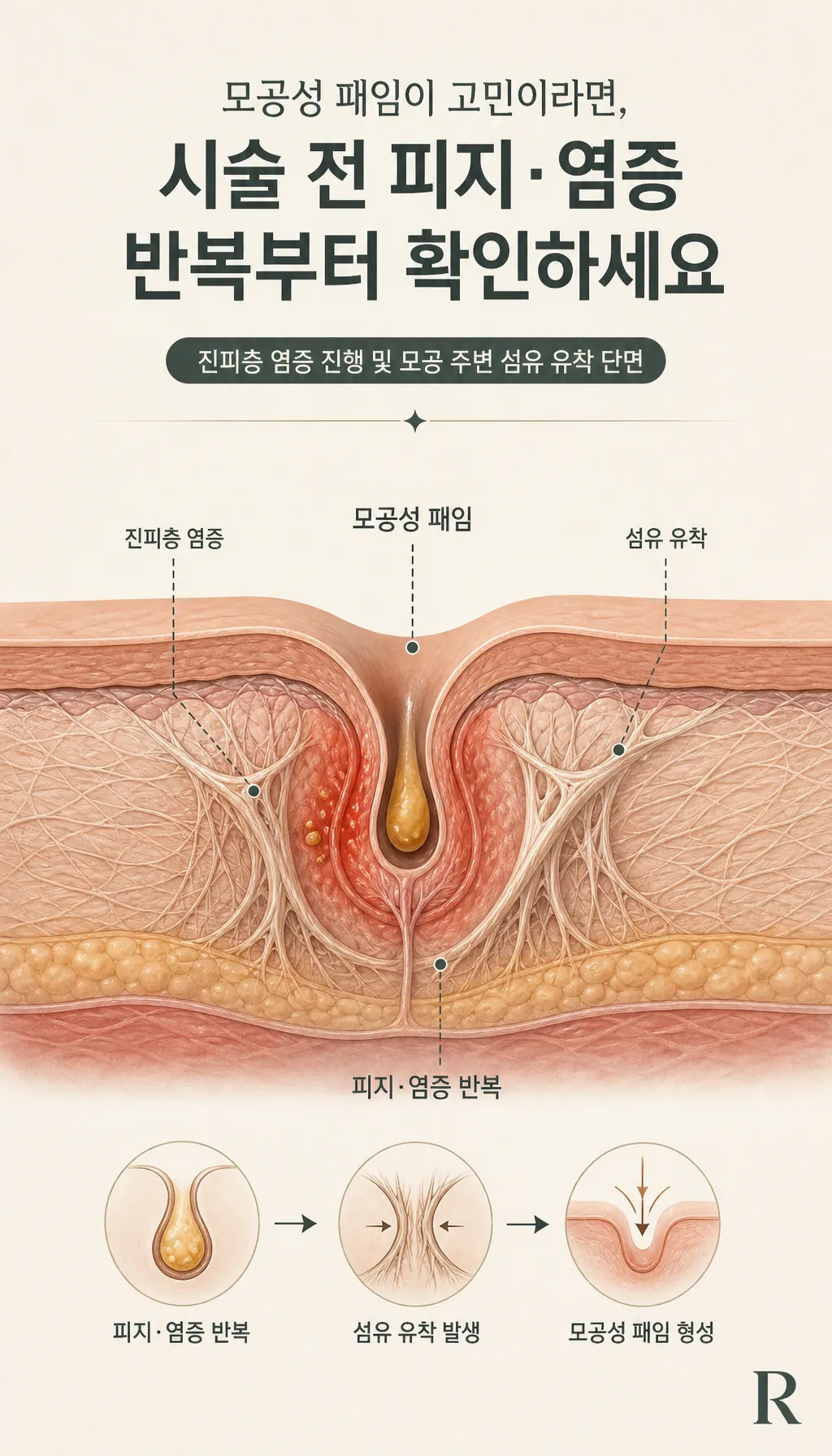 진피층 염증 진행 및 모공 주변 섬유 유착 단면