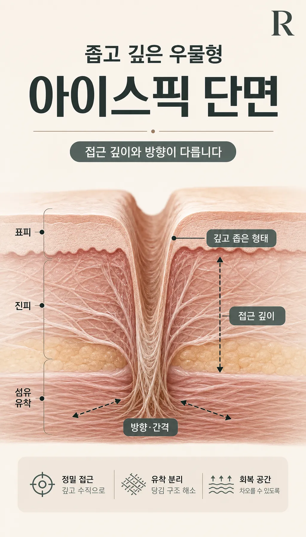 좁고 깊은 우물형 아이스픽 단면