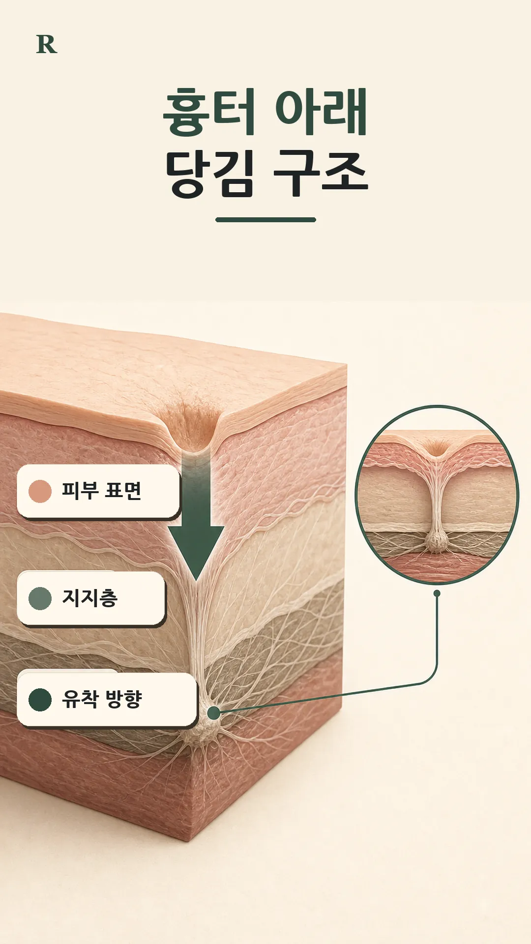 진피 아래 부착 차이 단면 도식
