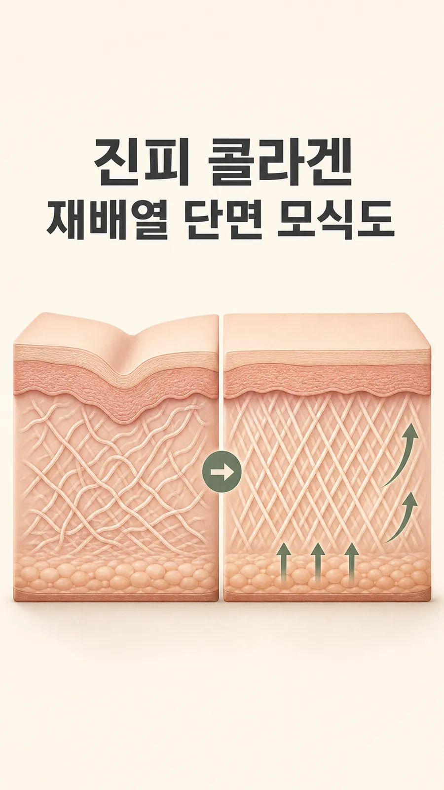 진피 콜라겐 재배열 단면 모식도