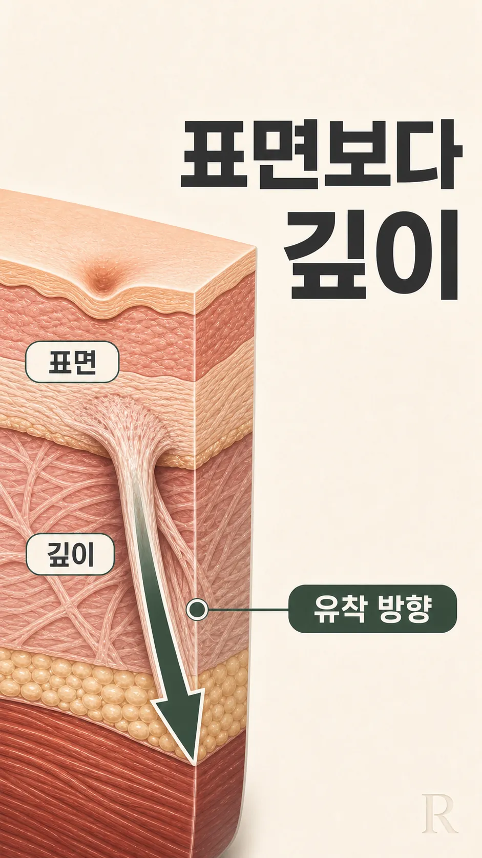 진피 콜라겐 유착 단면 모식도