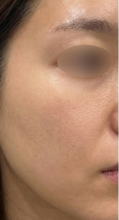 After-treatment image from a woman's mixed pitted-scar case at the same institution before its name change