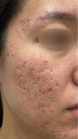 Before-treatment image from a woman's mixed pitted-scar case at the same institution before its name change