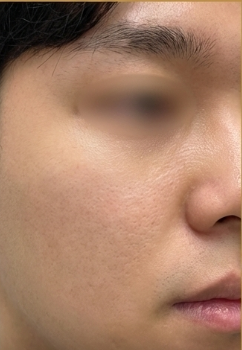 After-treatment image from a man's deep pitted-scar case at the same institution before its name change