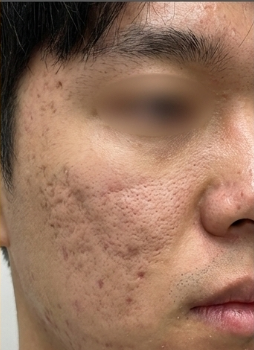 Before-treatment image from a man's deep pitted-scar case at the same institution before its name change