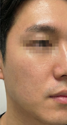 After-treatment image from a man's acne-scar and pore case at the same institution before its name change