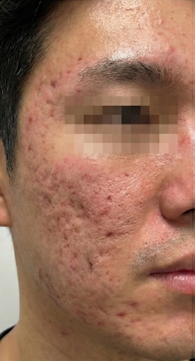 Before-treatment image from a man's acne-scar and pore case at the same institution before its name change