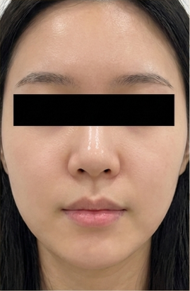 After-treatment image from a woman's inflammatory-acne case at the same institution before its name change