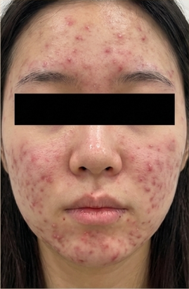 Before-treatment image from a woman's inflammatory-acne case at the same institution before its name change