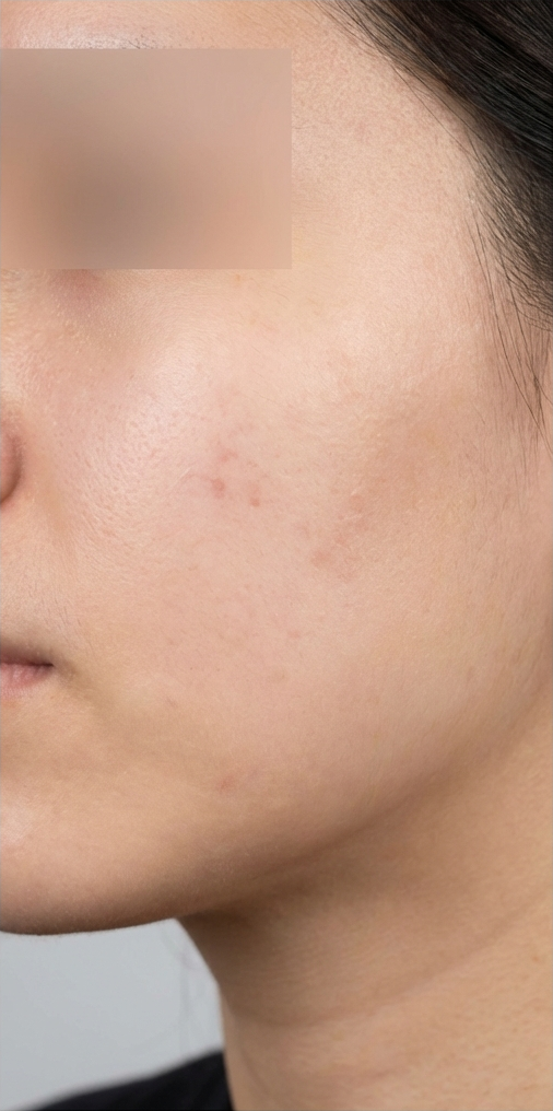 After-treatment image from a woman's acne and red-mark case at the same institution before its name change