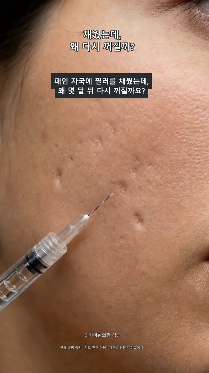 채웠는데 또 꺼진 흉터, 정말 덜 채워서일까요?